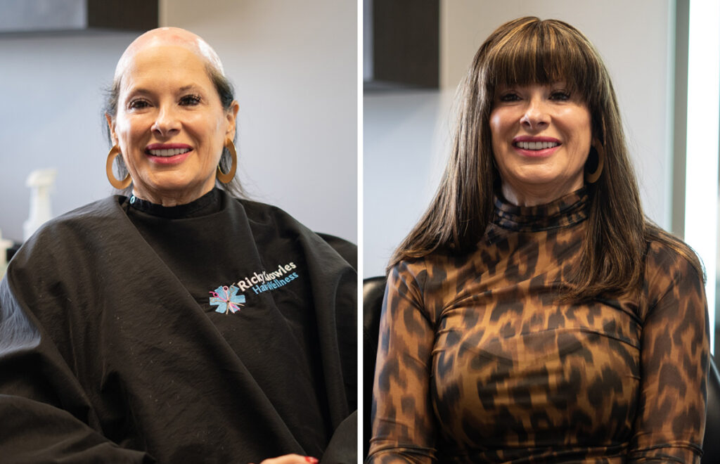 Smiling woman receiving non-invasive hair loss treatment
