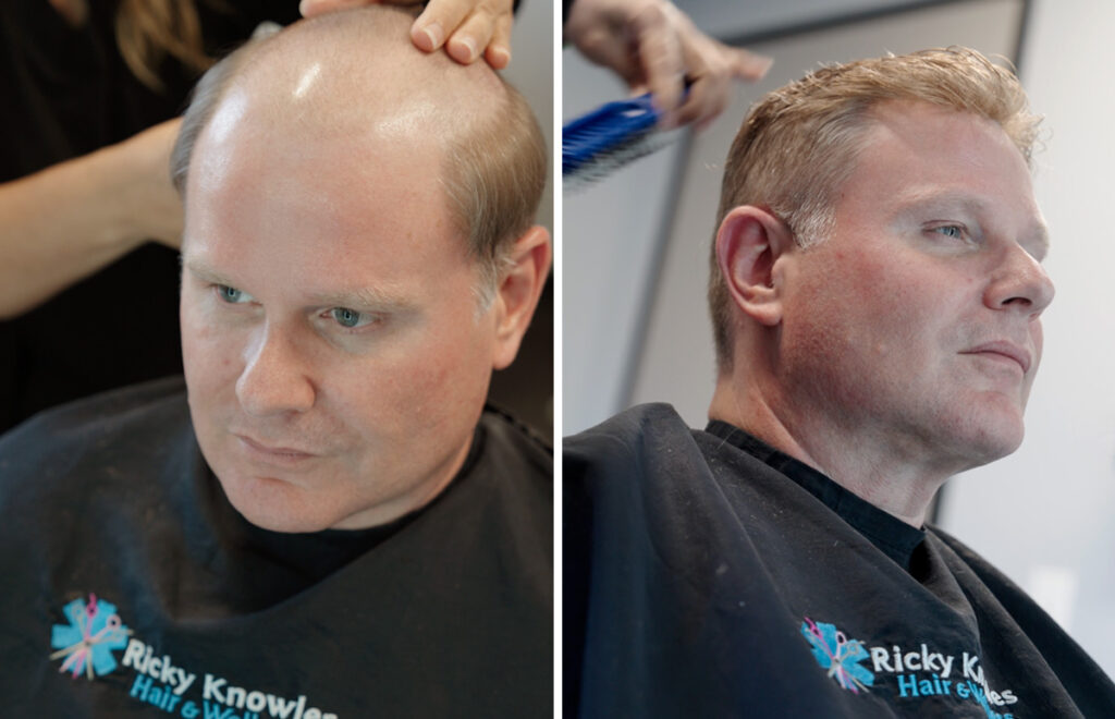 Ricky Knowles receiving non-invasive hair loss treatment